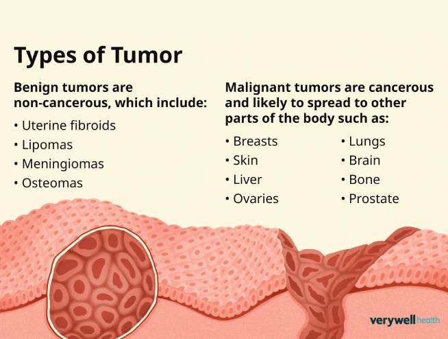 Any kind of tumor