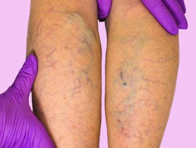 Varicose vain