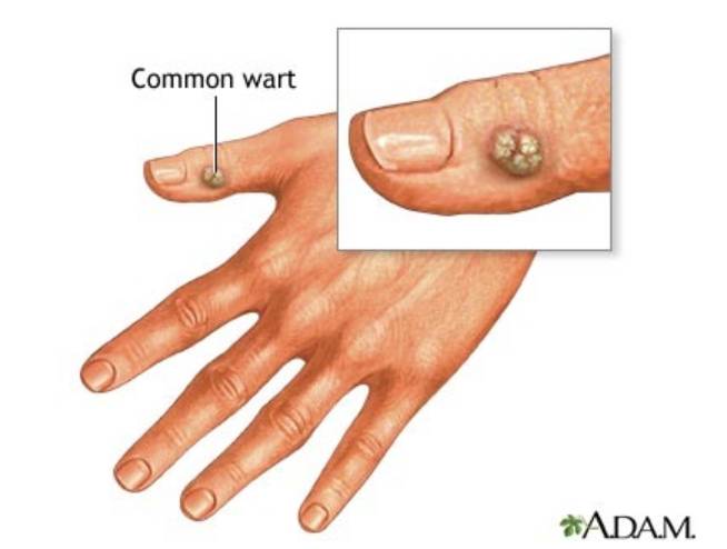 Warts( আঁচিল)