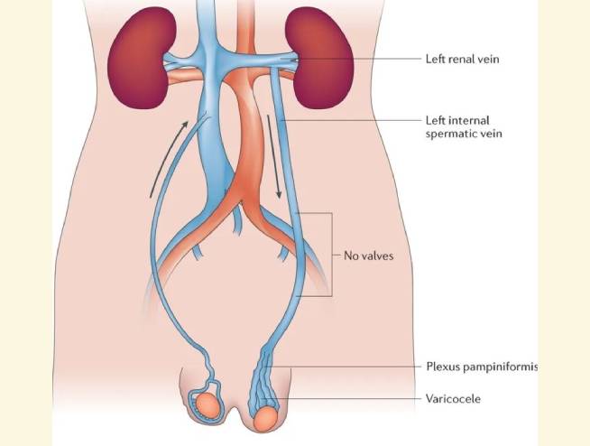 Varicocele vain