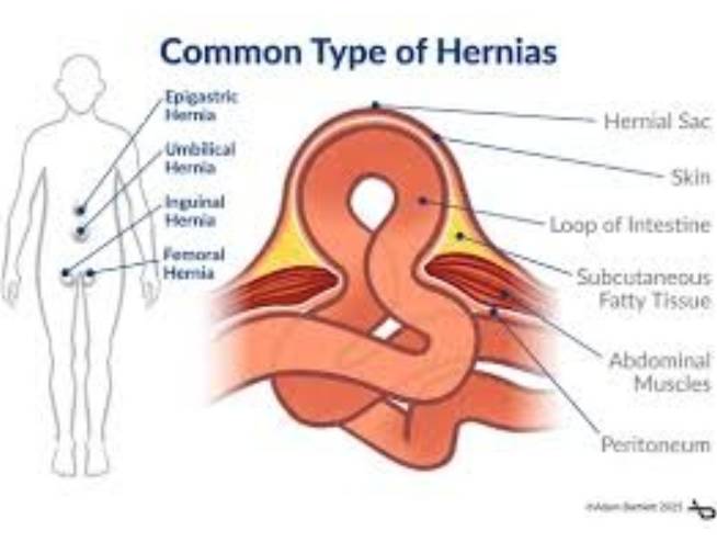 Hernia