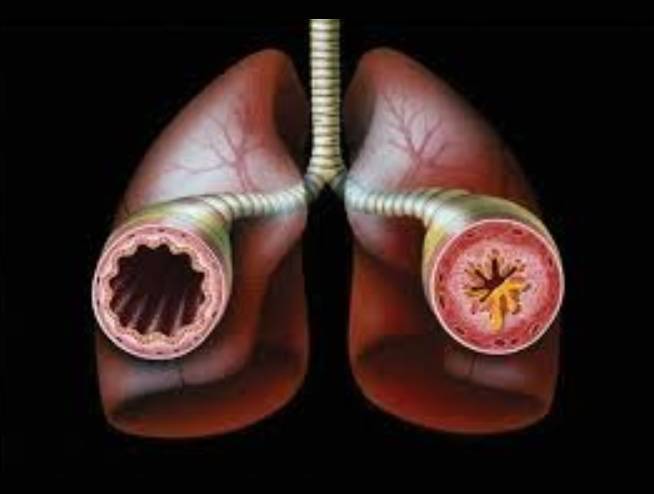 Bronchial Asma
