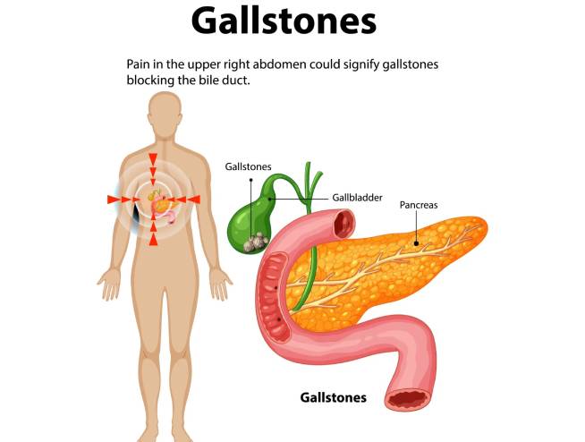 Gallstones