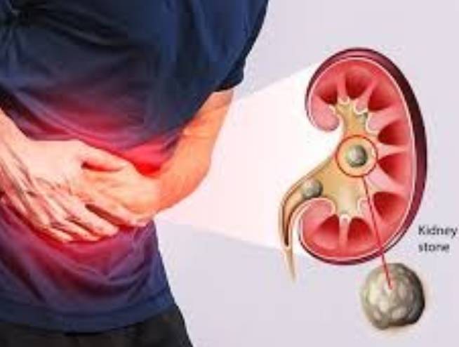 Kidney stone
