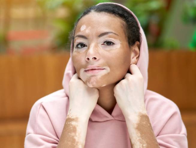 Leucoderma (vitility)